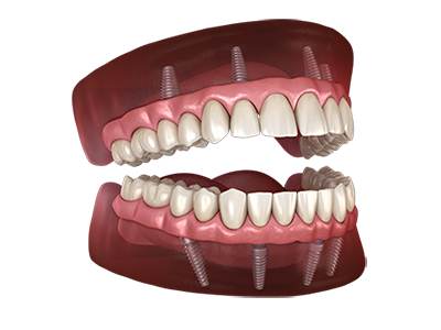 Permanent-Zirconia-Teeth-Double-Arch