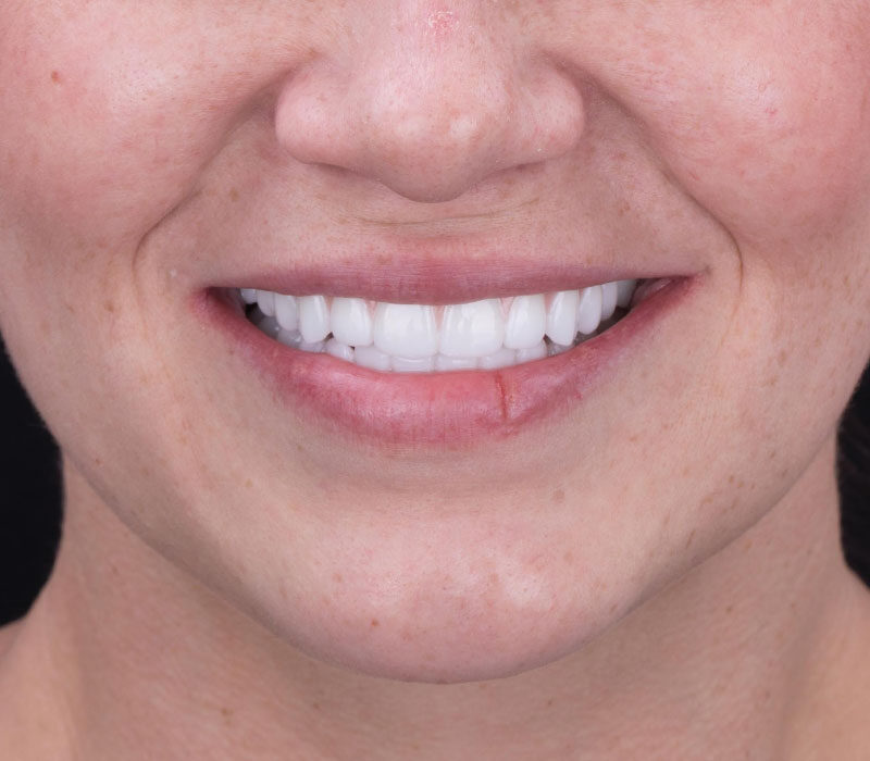 dental implants tennessee